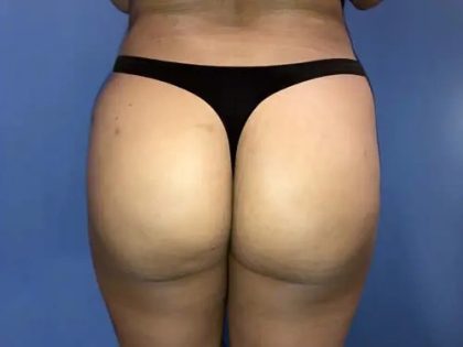 Brazilian Butt Lift Before & After Patient #21034