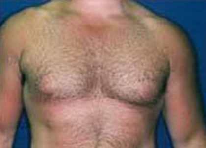 Gynecomastia Before & After Patient #21052