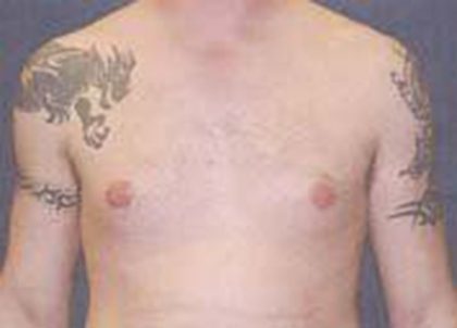 Gynecomastia Before & After Patient #21055
