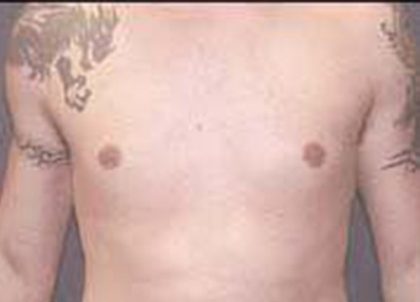 Gynecomastia Before & After Patient #21055