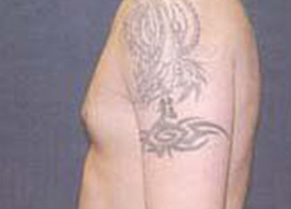 Gynecomastia Before & After Patient #21055