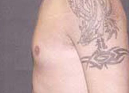 Gynecomastia Before & After Patient #21055