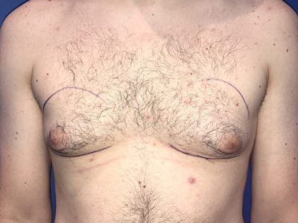 Gynecomastia Before & After Patient #21056