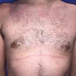 Gynecomastia Before & After Patient #21056