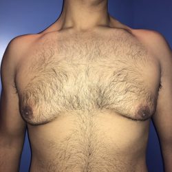 Gynecomastia Before & After Patient #21057