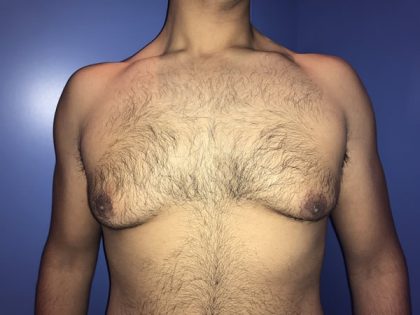 Gynecomastia Before & After Patient #21057