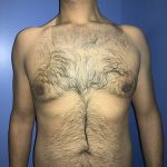 Gynecomastia Before & After Patient #21057
