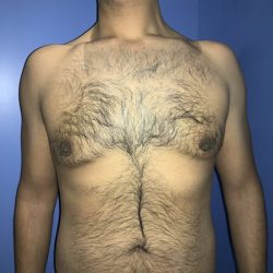 Gynecomastia Before & After Patient #21057