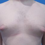 Gynecomastia Before & After Patient #21044