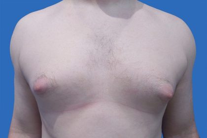 Gynecomastia Before & After Patient #21044