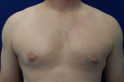 Gynecomastia Before & After Patient #21044