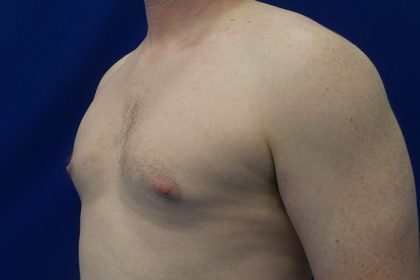 Gynecomastia Before & After Patient #21044
