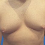 Gynecomastia Before & After Patient #21045