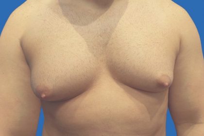 Gynecomastia Before & After Patient #21045