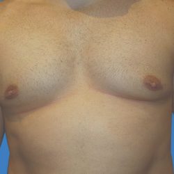 Gynecomastia Before & After Patient #21045