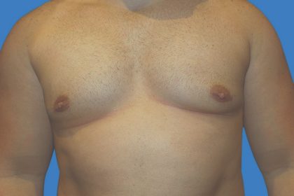 Gynecomastia Before & After Patient #21045