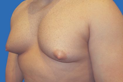 Gynecomastia Before & After Patient #21045