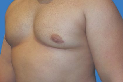 Gynecomastia Before & After Patient #21045