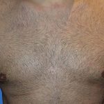 Gynecomastia Before & After Patient #21046