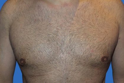 Gynecomastia Before & After Patient #21046