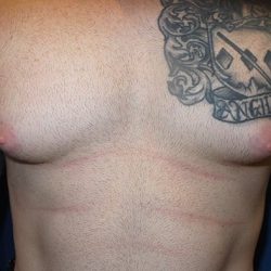 Gynecomastia Before & After Patient #21047