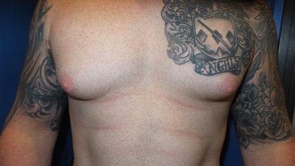 Gynecomastia Before & After Patient #21047