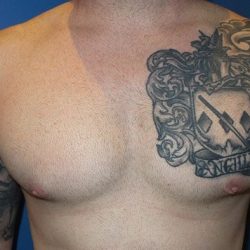 Gynecomastia Before & After Patient #21047