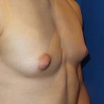 Gynecomastia Before & After Patient #21048