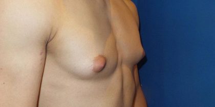 Gynecomastia Before & After Patient #21048