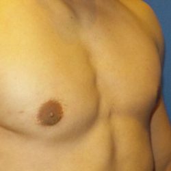 Gynecomastia Before & After Patient #21048