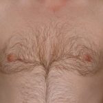 Gynecomastia Before & After Patient #21049
