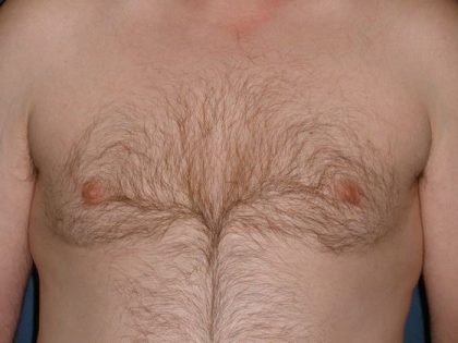 Gynecomastia Before & After Patient #21049