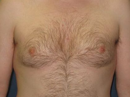 Gynecomastia Before & After Patient #21049