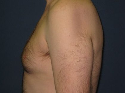 Gynecomastia Before & After Patient #21049