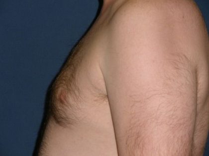 Gynecomastia Before & After Patient #21049