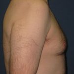 Gynecomastia Before & After Patient #21049