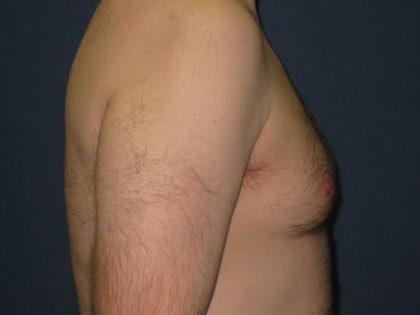 Gynecomastia Before & After Patient #21049