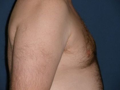 Gynecomastia Before & After Patient #21049