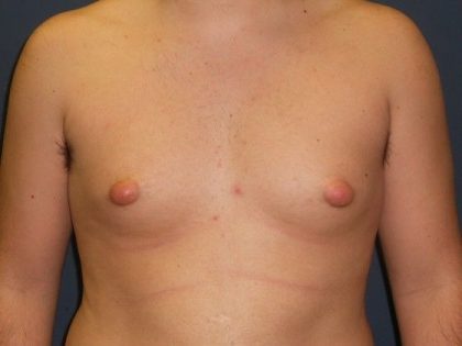 Gynecomastia Before & After Patient #21050