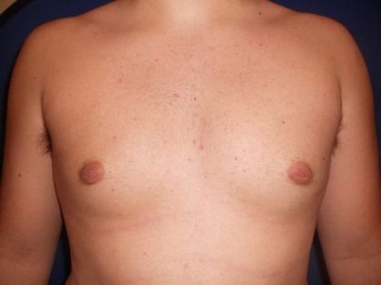 Gynecomastia Before & After Patient #21050