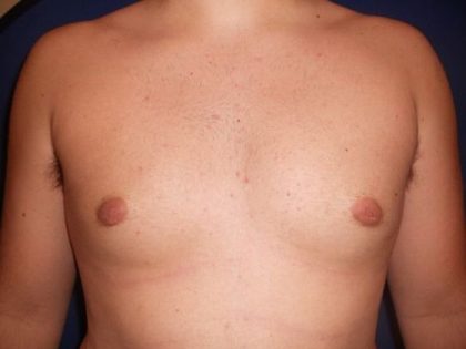 Gynecomastia Before & After Patient #21050