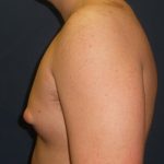 Gynecomastia Before & After Patient #21050