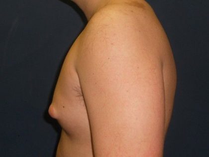 Gynecomastia Before & After Patient #21050