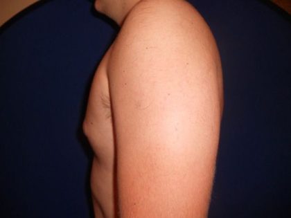 Gynecomastia Before & After Patient #21050