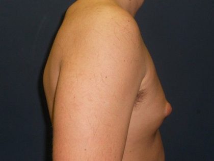 Gynecomastia Before & After Patient #21050