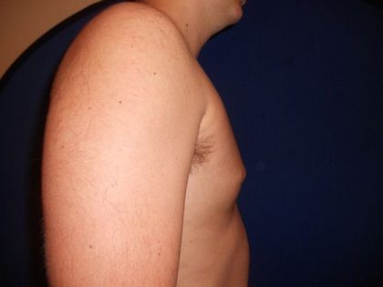 Gynecomastia Before & After Patient #21050