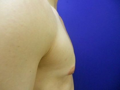 Gynecomastia Before & After Patient #21051