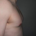 Gynecomastia Before & After Patient #21051