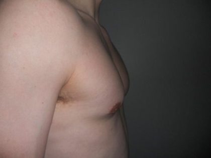 Gynecomastia Before & After Patient #21051