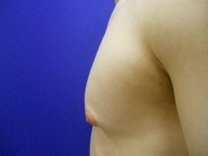 Gynecomastia Before & After Patient #21051